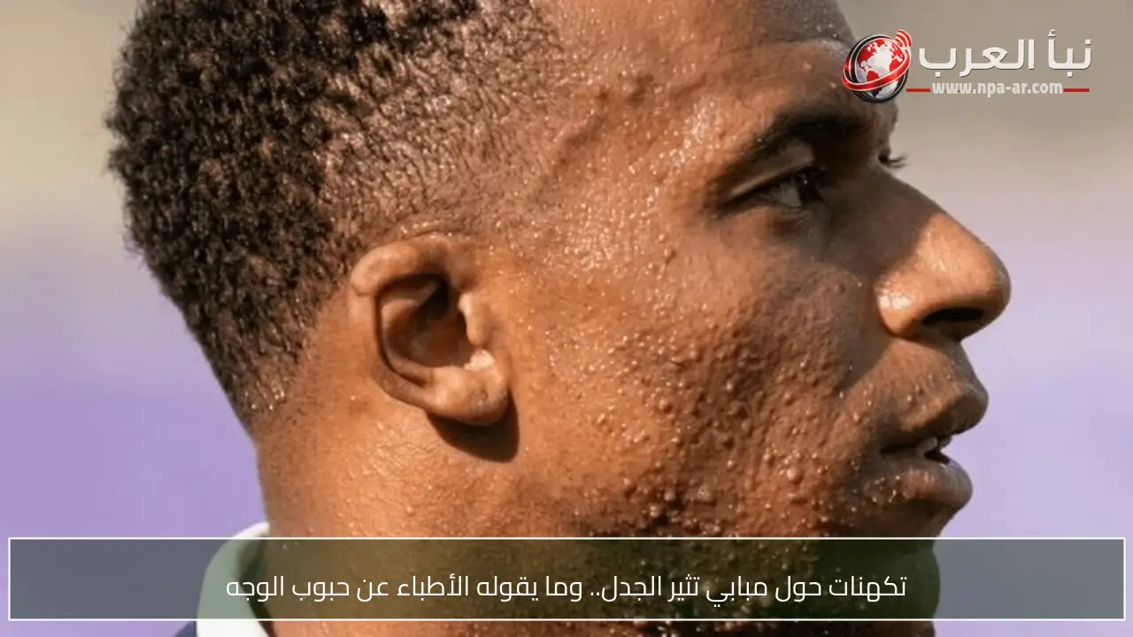تكهنات حول مبابي تثير الجدل.. وما يقوله الأطباء عن حبوب الوجه