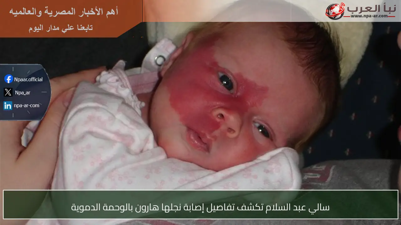 سالي عبد السلام تكشف تفاصيل إصابة نجلها هارون بالوحمة الدموية