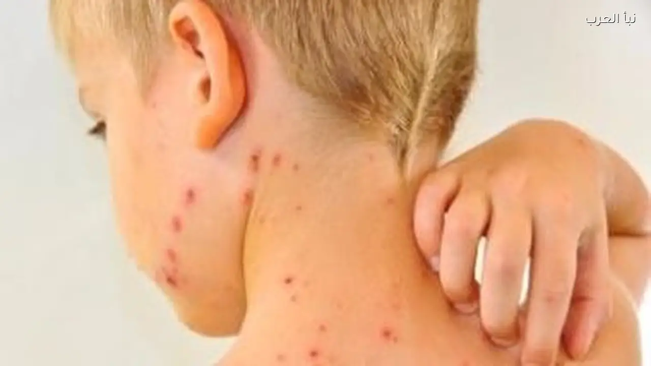 فاكسيرا تحذر من مضاعفات الجديري المائي وتدعو لتطعيم الأطفال