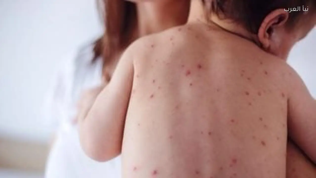 وفاة 15 طفلاً في إسرائيل جراء تفشي الحصبة